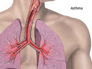 patients-asthma1