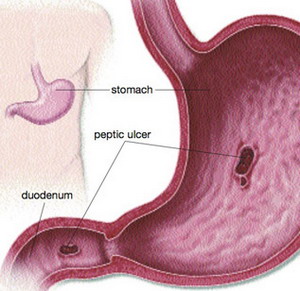 peptic-ulcer