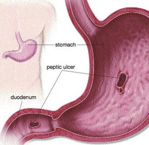 curling ulcer
