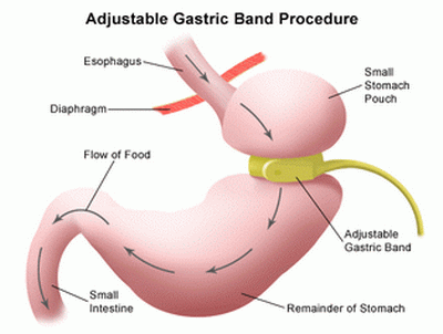 Metabolic Bariatric Surgery