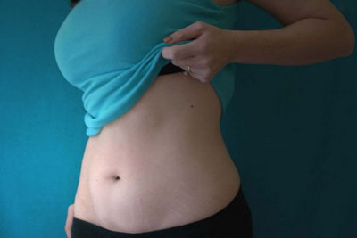 Treating Stretch Marks